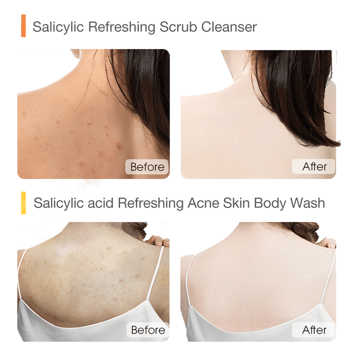 Salicylic Acid Fresh Acne Body Care Set - SKINEVER - 