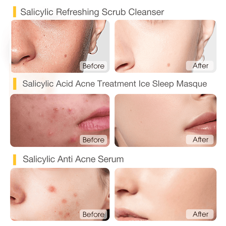 Triple Deep Acne Clearing Set - SKINEVER - 